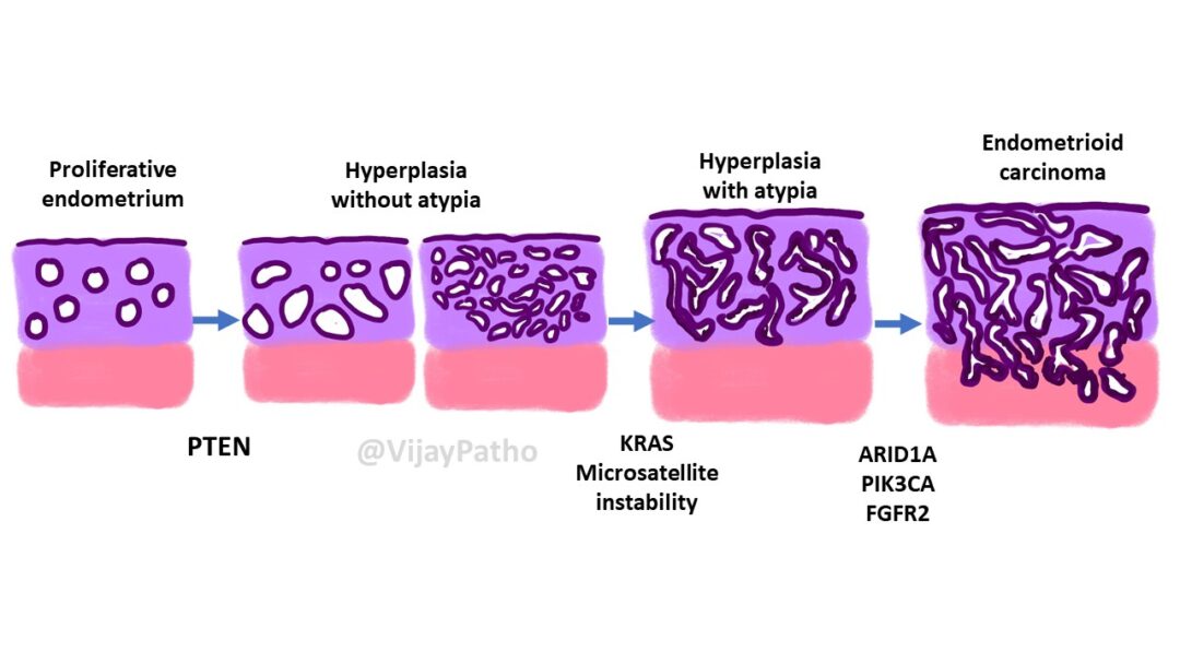 Pathology of Endometrial Carcinoma - Pathology Made Simple