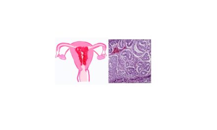 Pathology of Endometrial Carcinoma