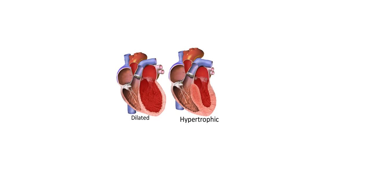 cardiomyopathy:  Dilated and Hypertrophic