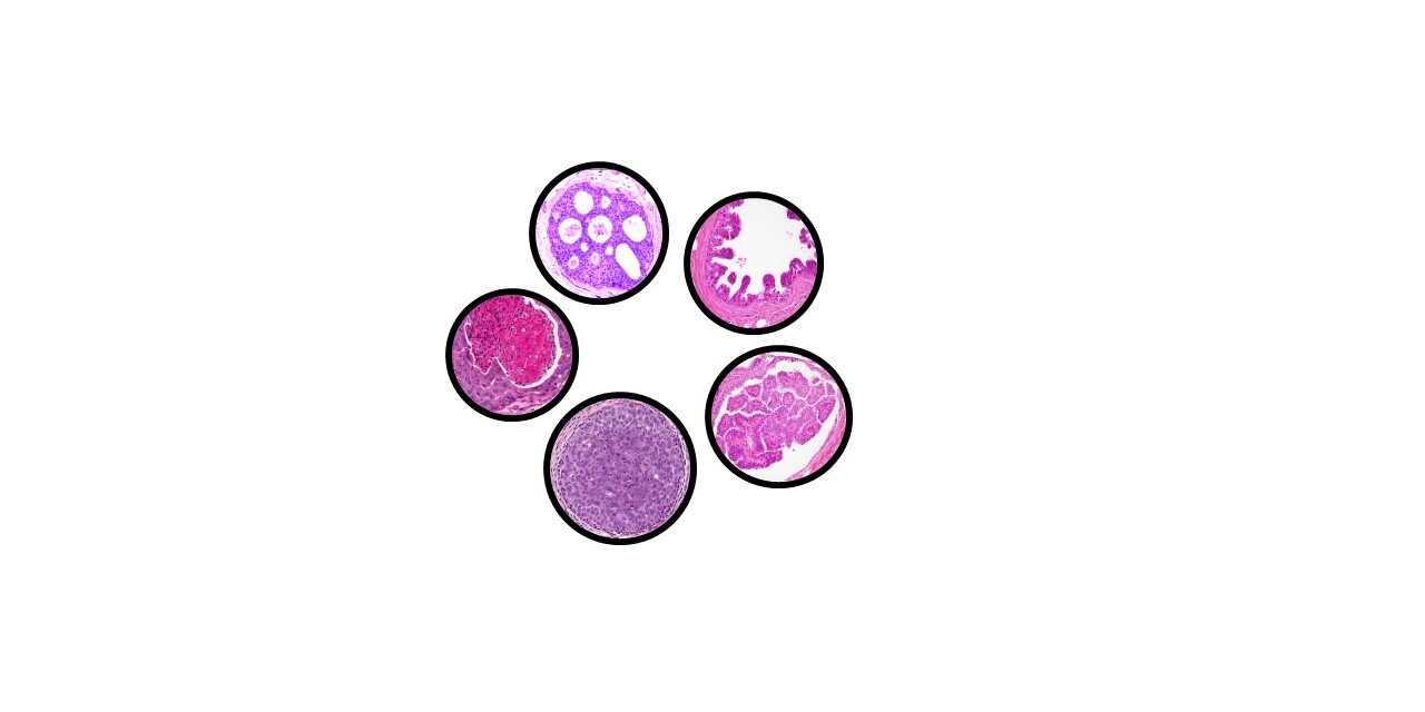 Ductal Lobular Carcinoma In Situ Breast Pathology Made Simple