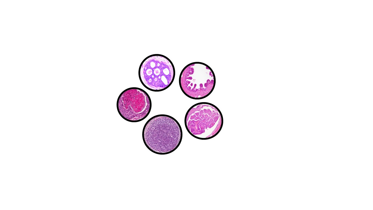 ductal-lobular-carcinoma-in-situ-breast-pathology-made-simple