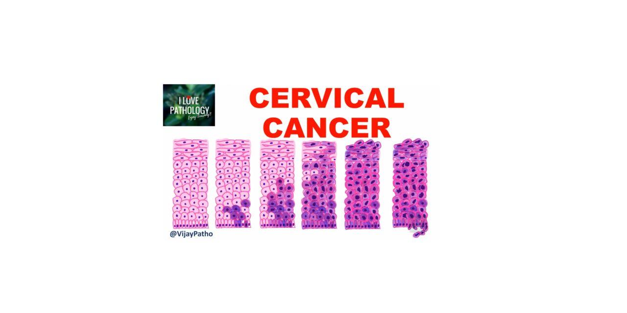 Cervical intraepithelial neoplasia & cervical cancer