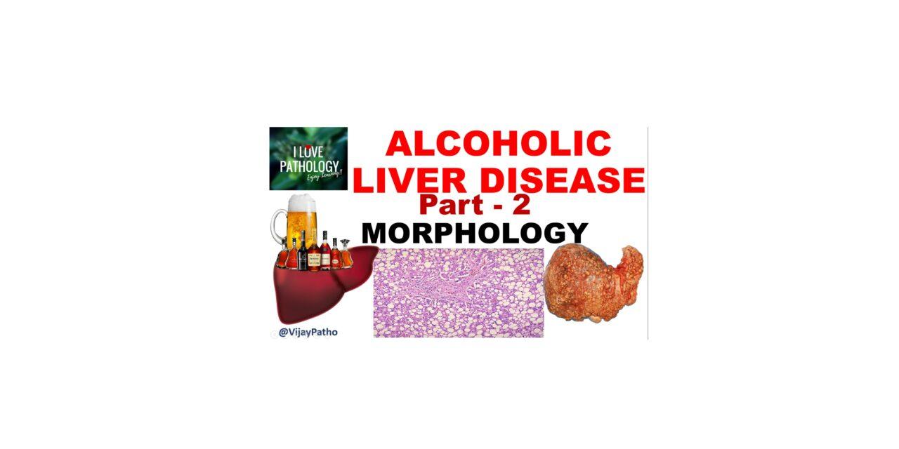 Alcoholic liver disease: Morphology, Clinical features & Complications