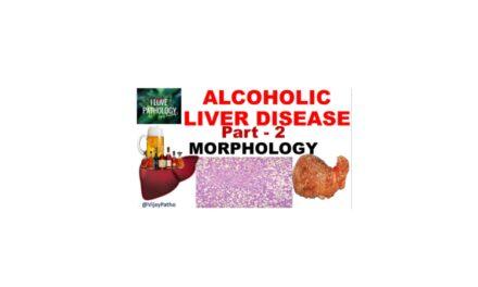 Alcoholic liver disease: Morphology, Clinical features & Complications