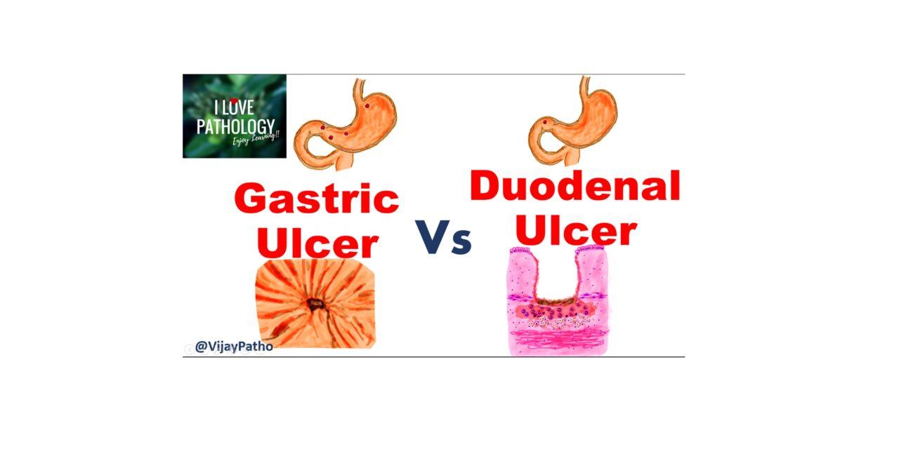 GASTRIC vs DUODENAL ULCERS