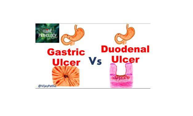 GASTRIC vs DUODENAL ULCERS