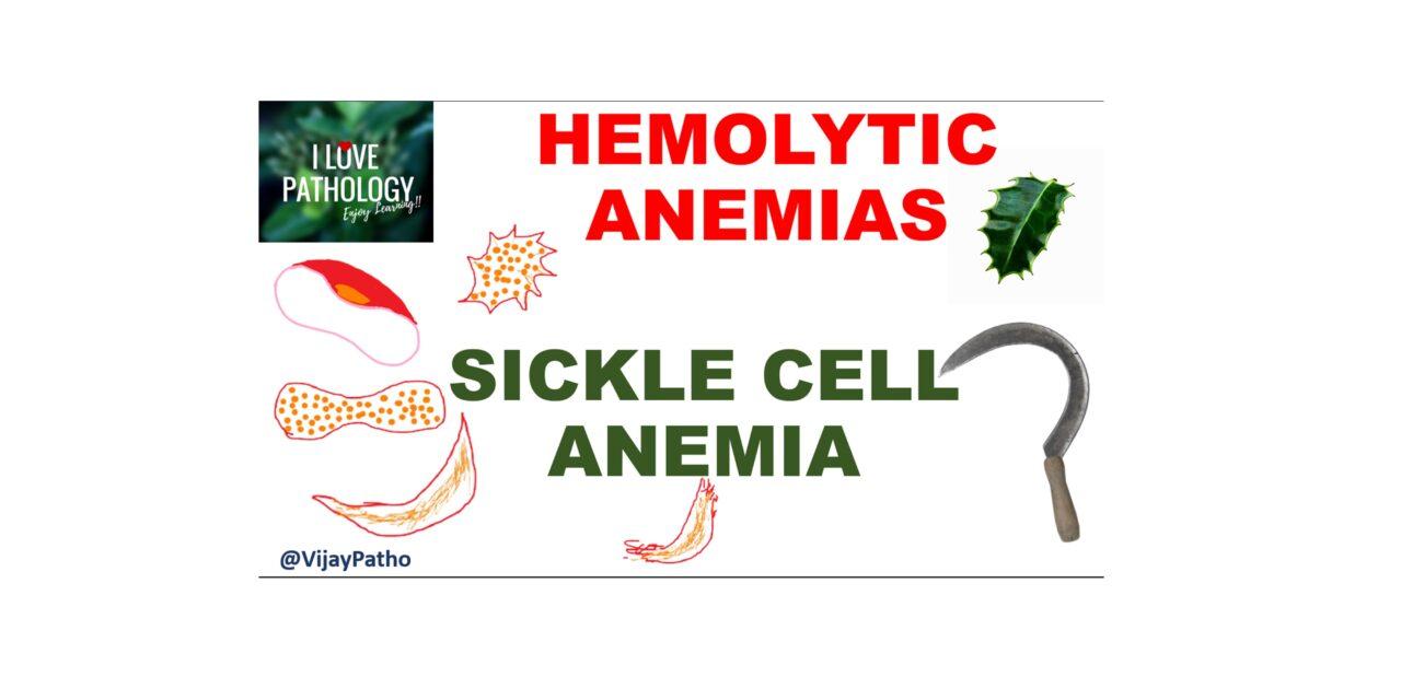 HEMOLYTIC ANEMIA –  SICKLE CELL ANEMIA