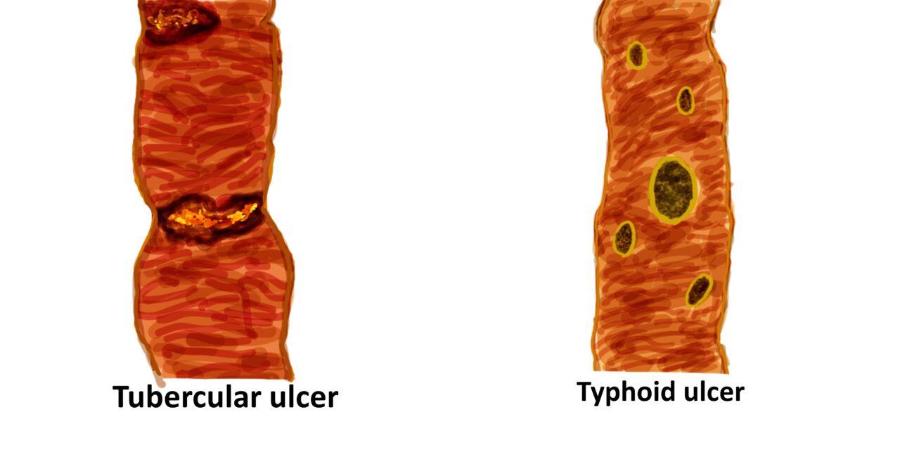 Tubercular vs Typhoid ulcer