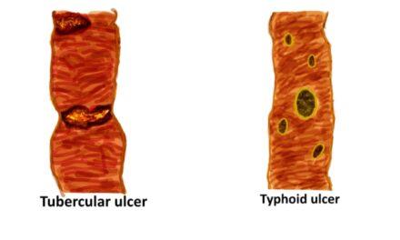 Tubercular vs Typhoid ulcer