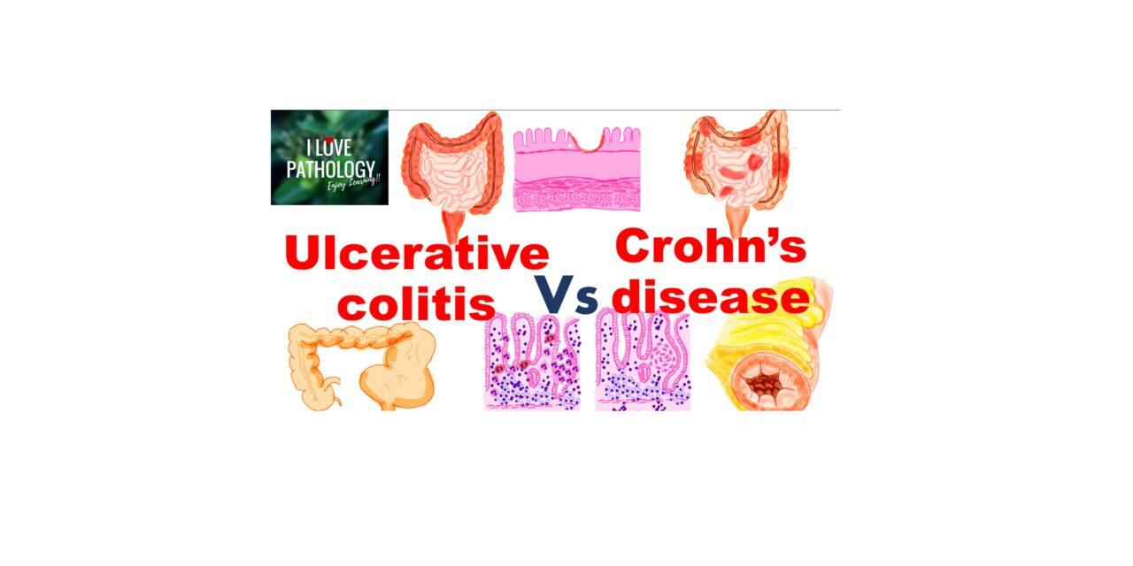 ULCERATIVE COLITIS vs CROHNS DISEASE