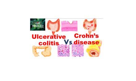 ULCERATIVE COLITIS vs CROHNS DISEASE