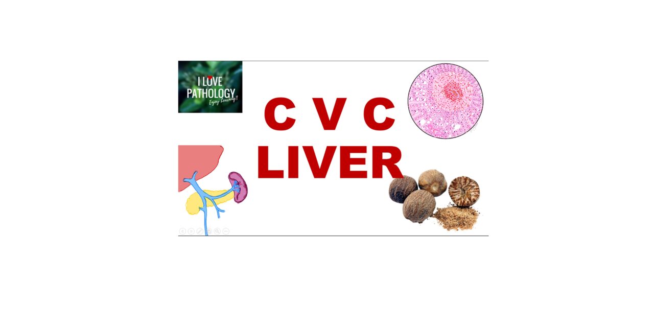 Chronic Venous Congestion – Liver