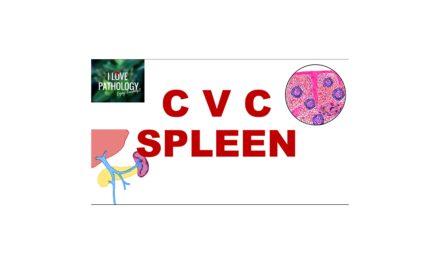 Chronic Venous Congestion : Spleen