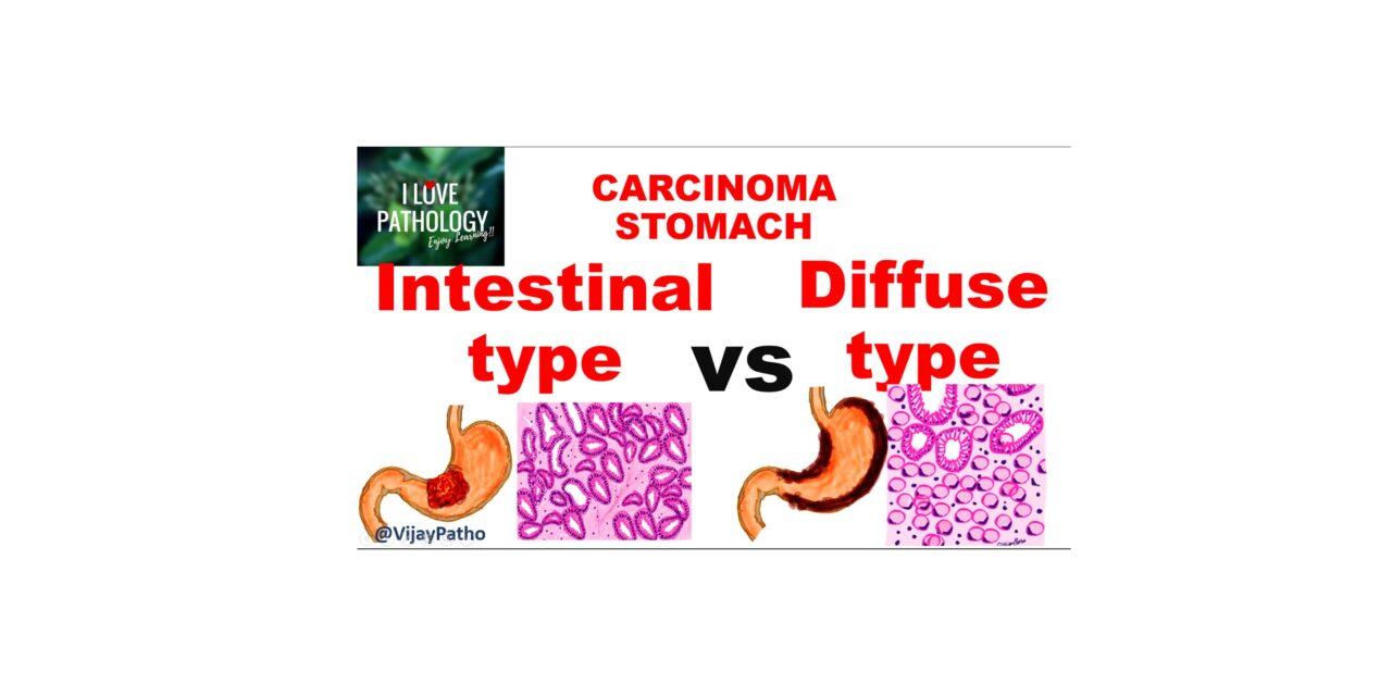 gastric cancer types