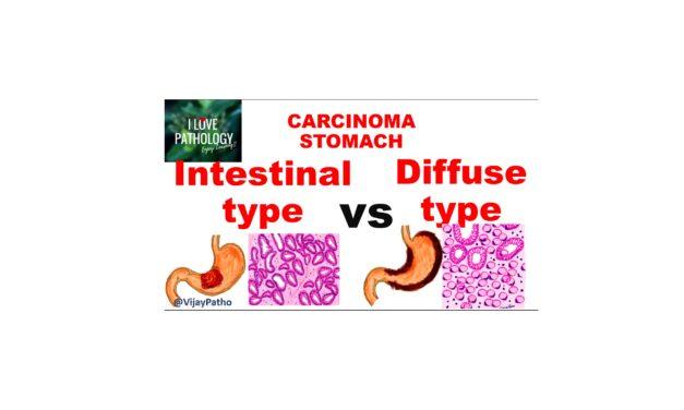 Carcinoma Stomach: INTESTINAL VS DIFFUSE GASTRIC CANCER