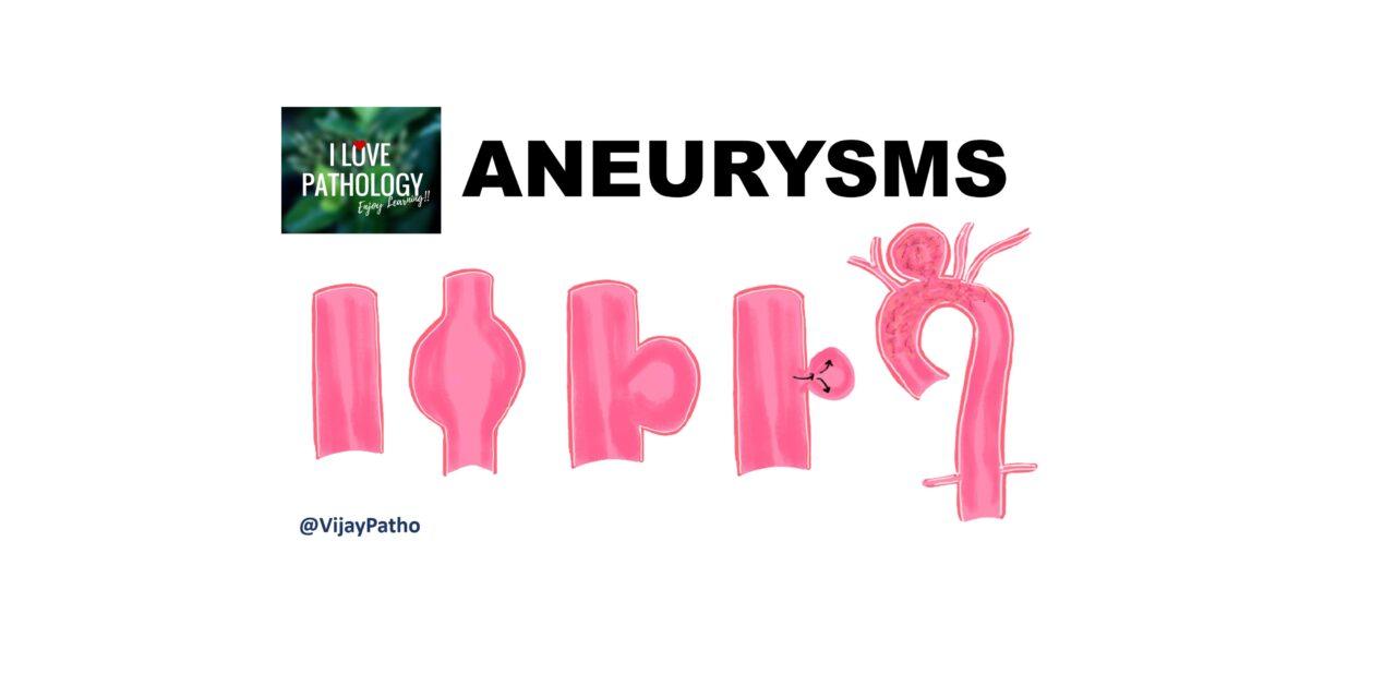 Aneurysms: Types, Causes, and Management
