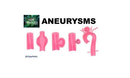 Aneurysms: Types, Causes, and Management