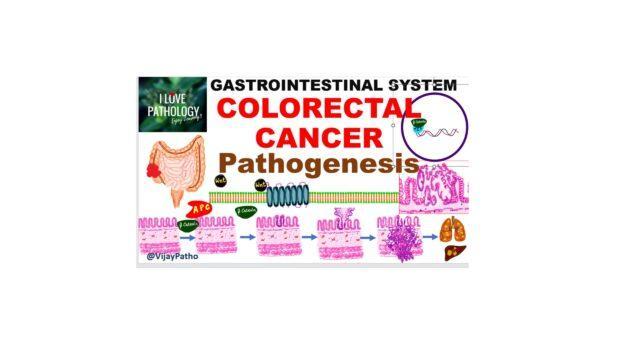 Pathogenesis Of Colorectal Cancer Pathology Made Simple