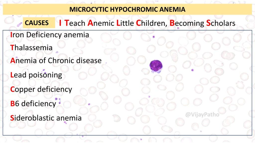 Mild Microcytic Hypochromic Anemia Treatment WXCQRB