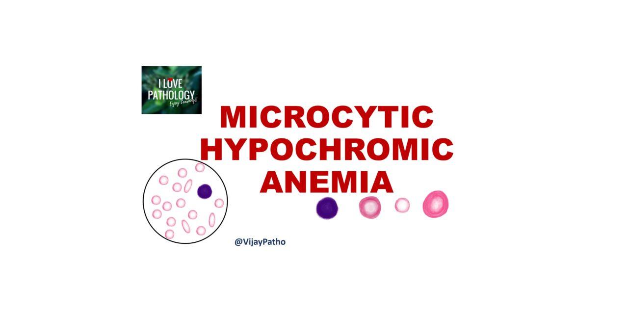  Microcytic Hypochromic Anemia: Causes and Diagnosis