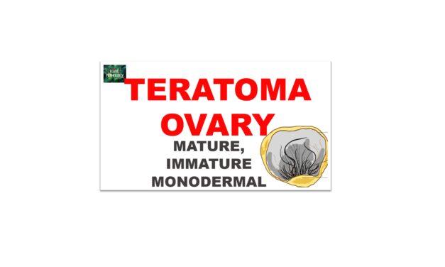 Ovarian Teratoma