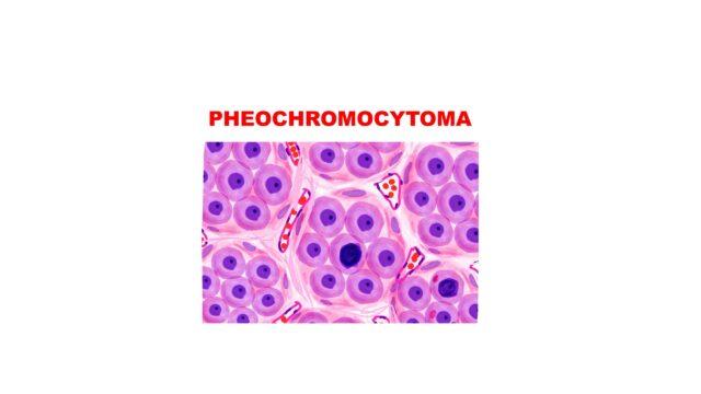 Pheochromocytoma Pathology Pathology Made Simple 7293