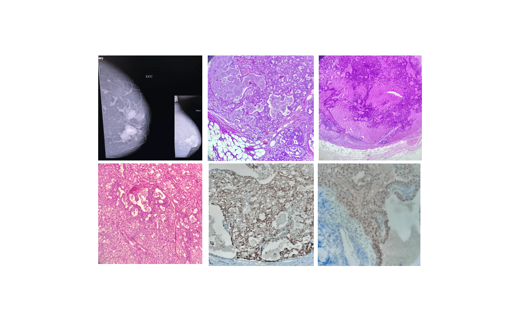 Pathology of Secretory Breast Carcinoma