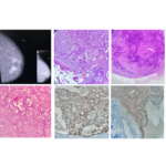 Pathology of Secretory Breast Carcinoma