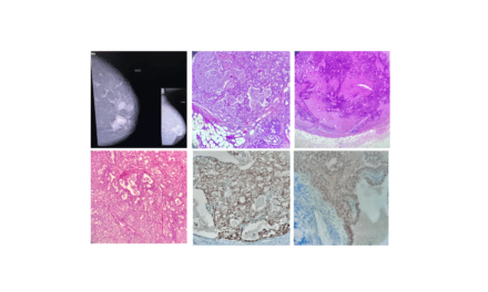 Pathology of Secretory Breast Carcinoma