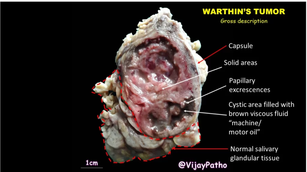 GROSS FEATURES OF WARTHIN TUMOR