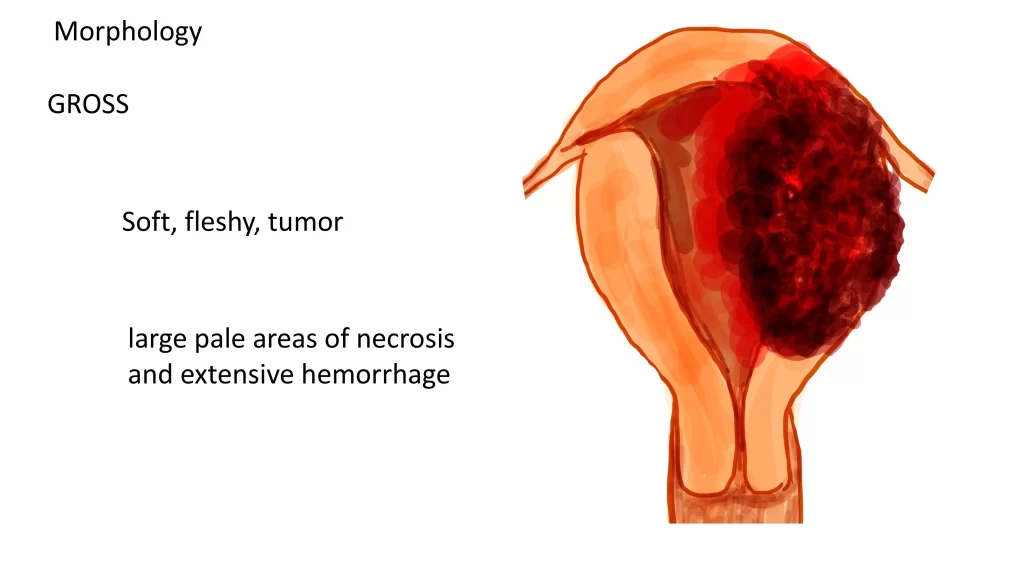 CHORIOCARCINOMA