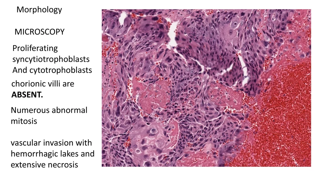 choriocarcinoma