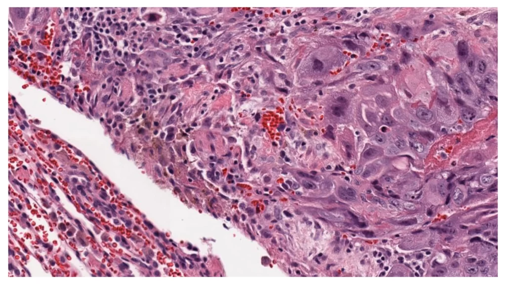 choriocarcinoma