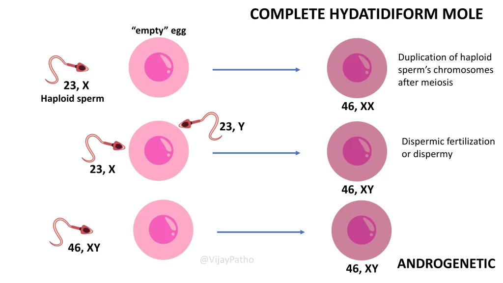 Pathogenesis of complete hydatidiform mole