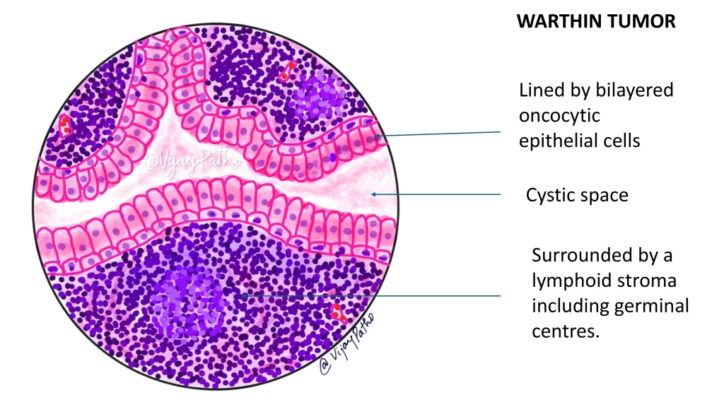 MICROSCOPIC FEATURES OF WARTHIN TUMOR