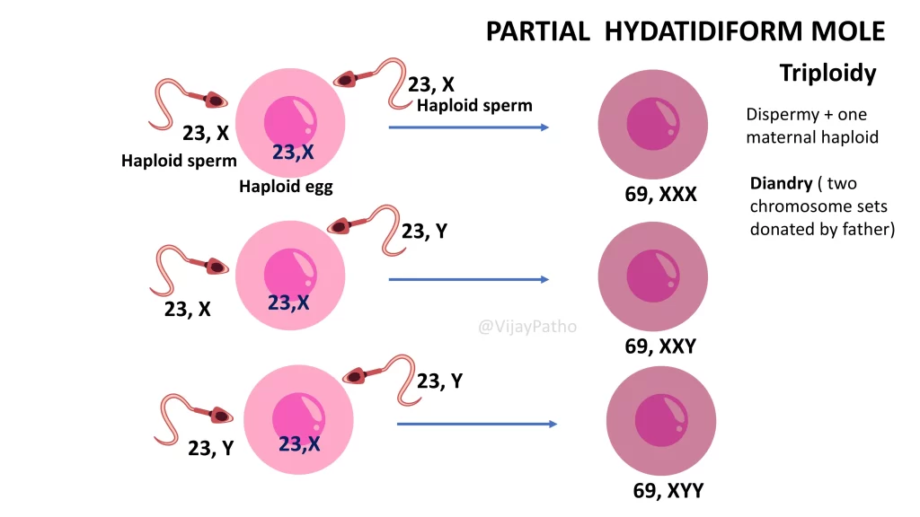 Pathogenesis of Partial Hydatidifrom mole