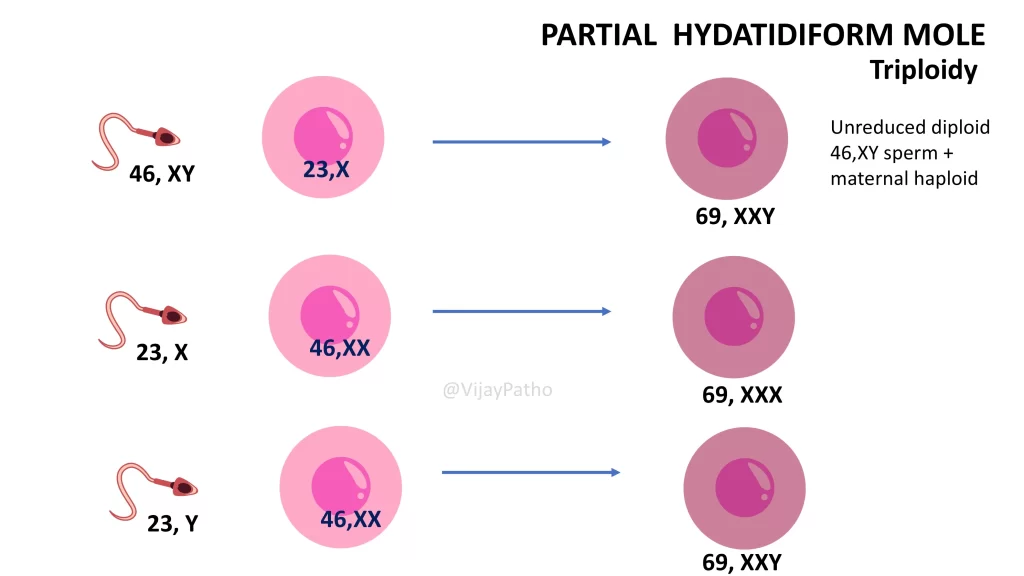 Pathogenesis of Partial Hydatidifrom mole