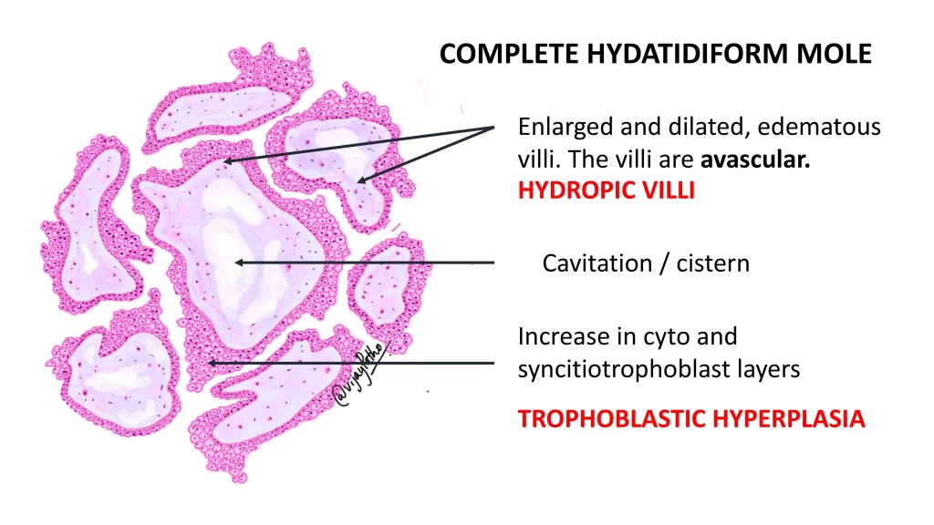 complete hydatidiform mole