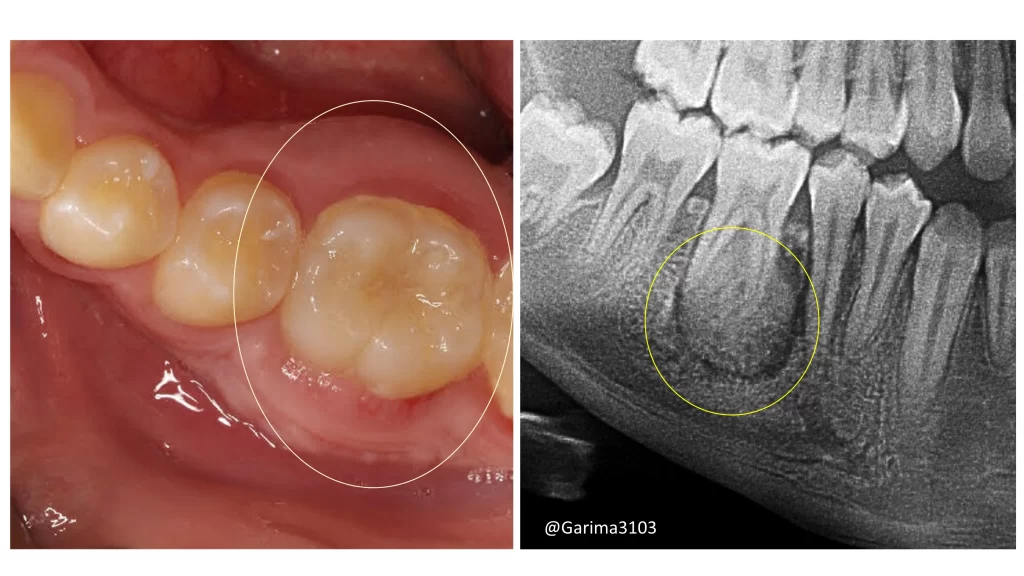 cementoblastoma clinical and radiologic image