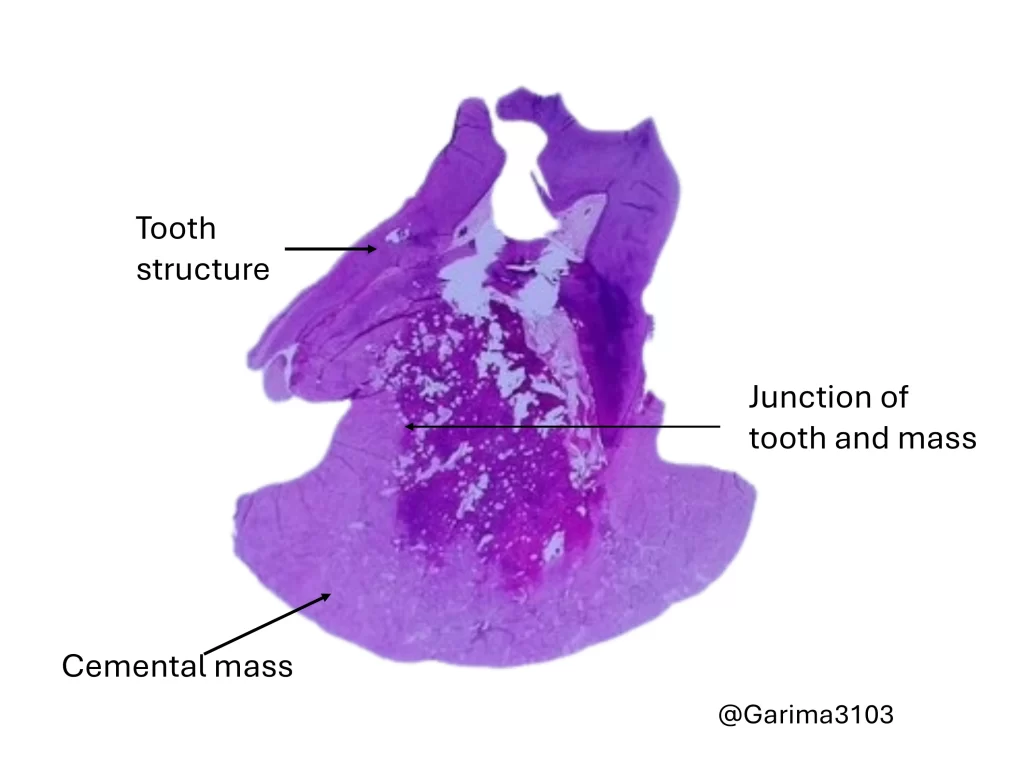 Cementoblastoma