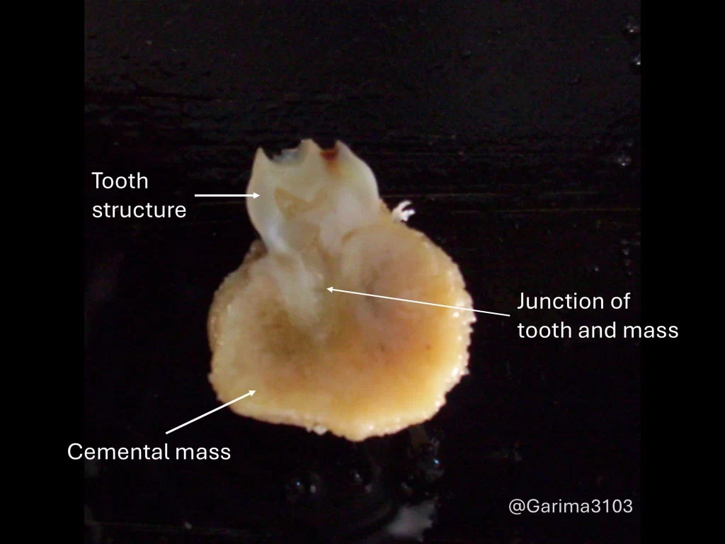 gross photo of cementoblastoma