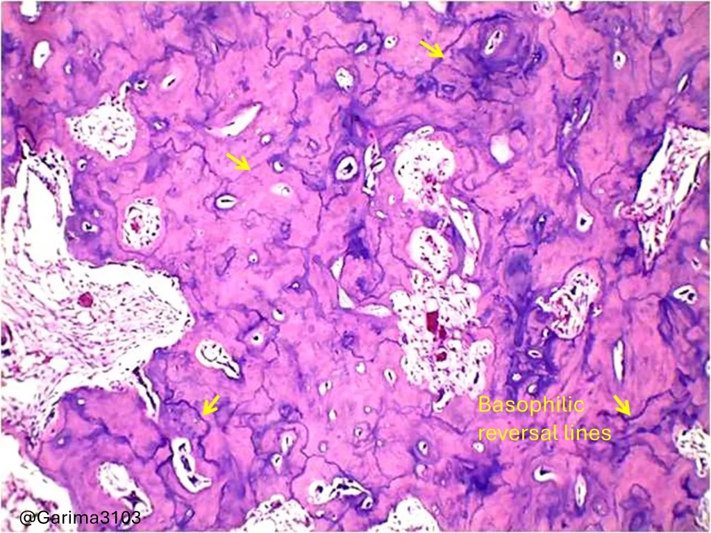 cementoblastoma basophilic reversal lines