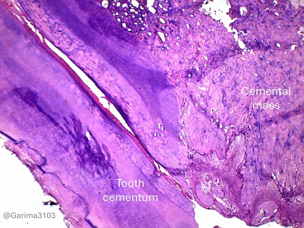 cemental mass with basophilic reversal lines adjacent to tooth cementum