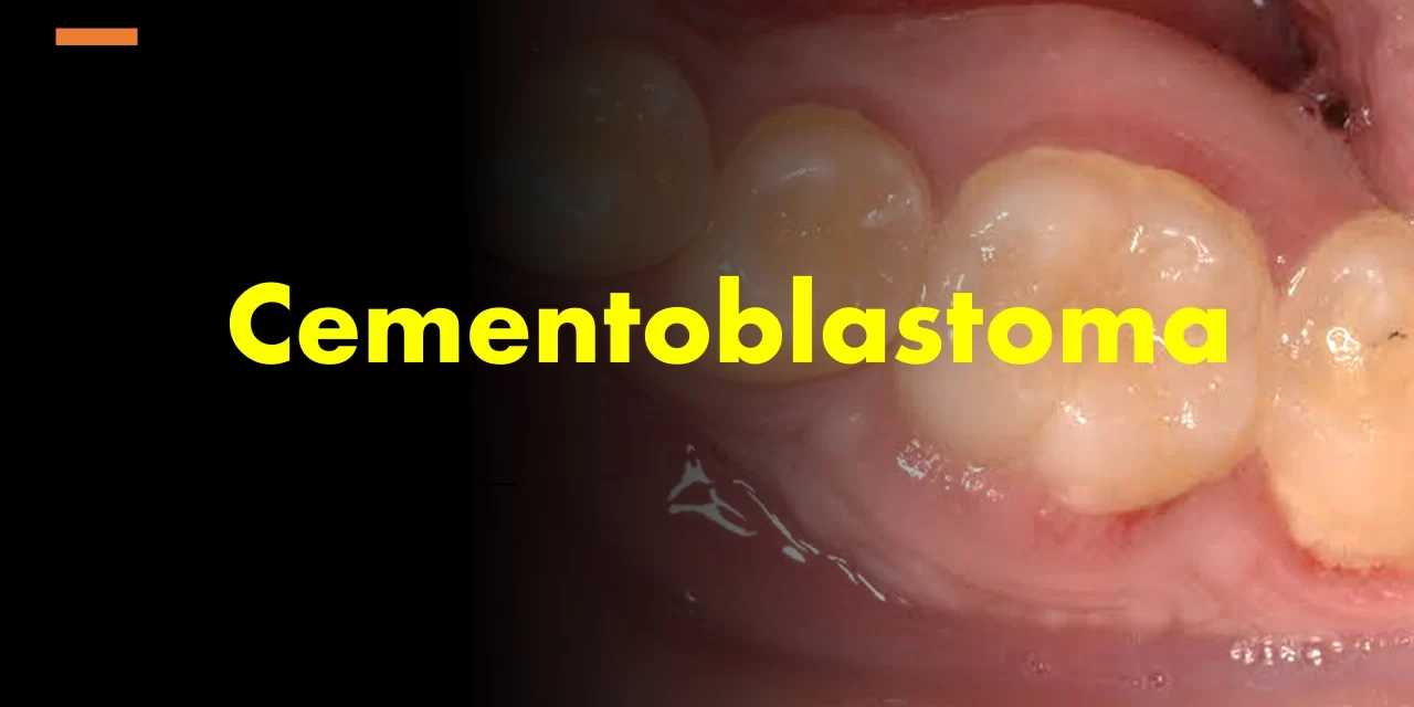 Cementoblastoma