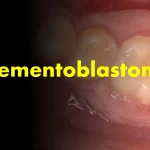 cementoblastoma