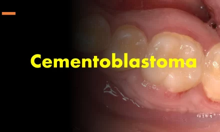 Cementoblastoma