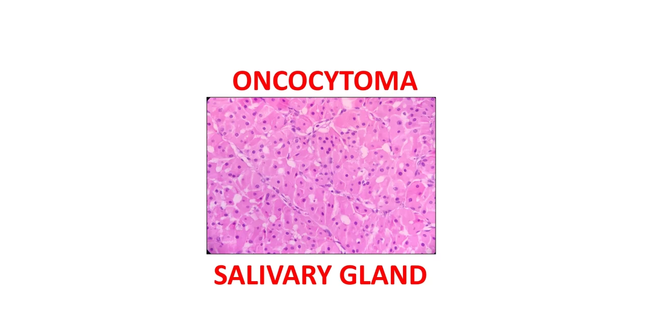 Oncocytoma