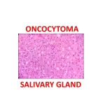 ONCOCYTOMA