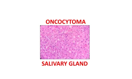 Oncocytoma