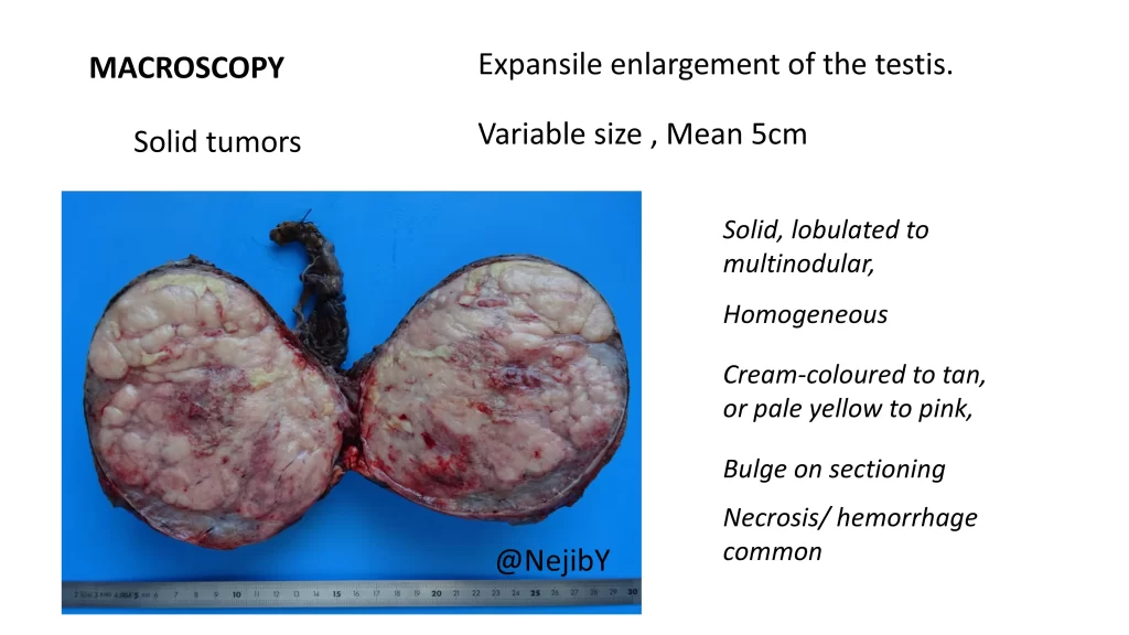 Seminoma gross features 